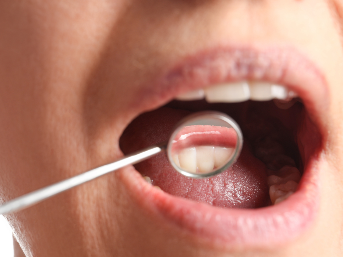 periodontittbehandling