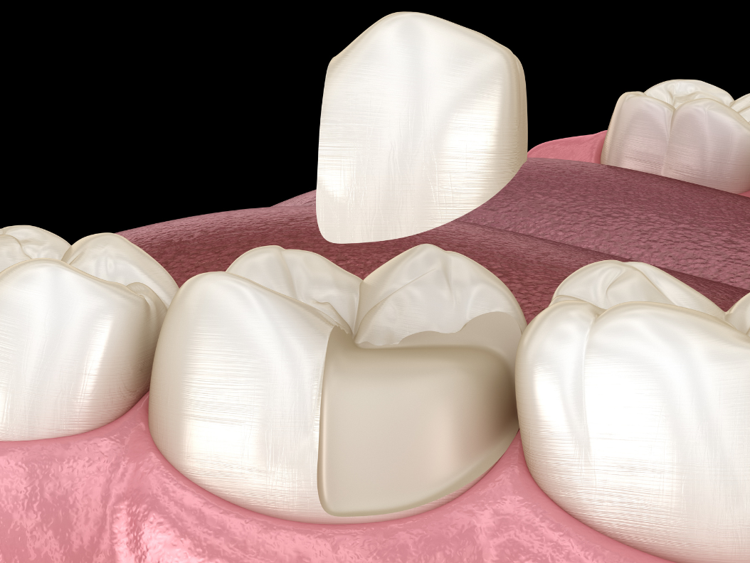 kroner, broer og innlegg