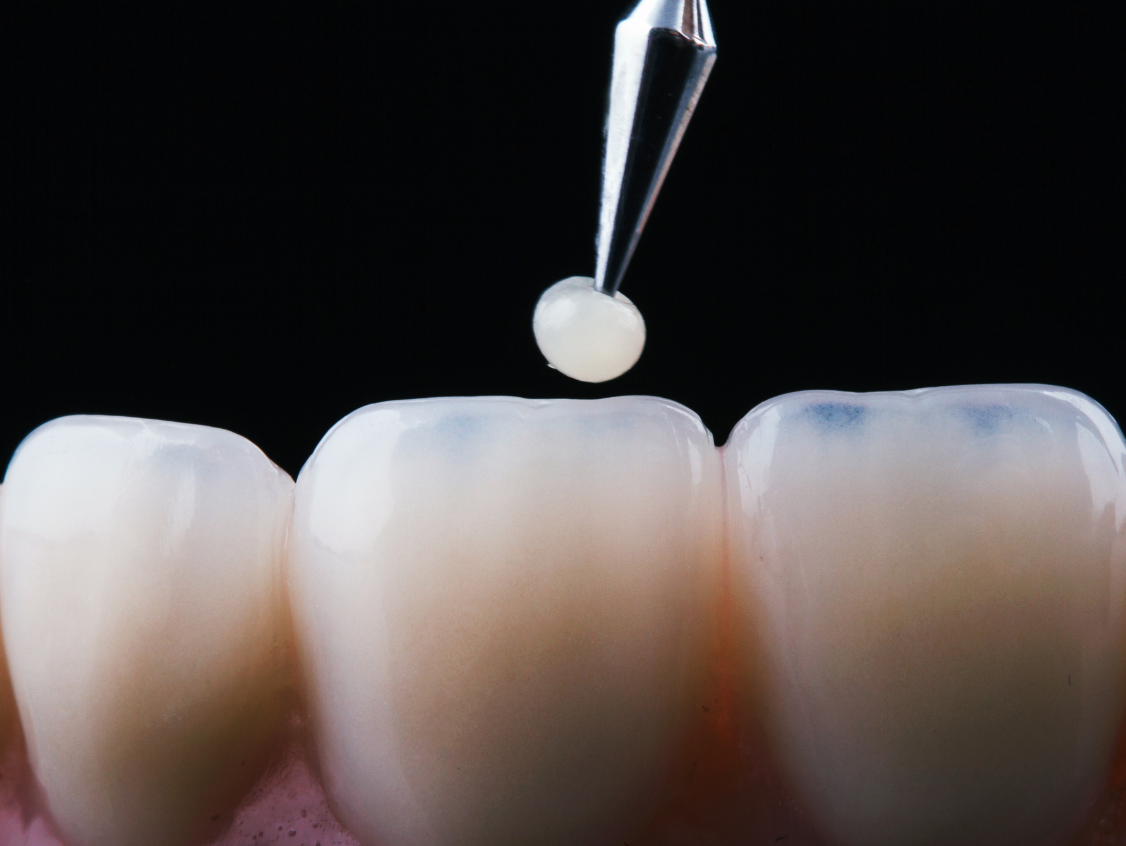 fyllinger og restaurering